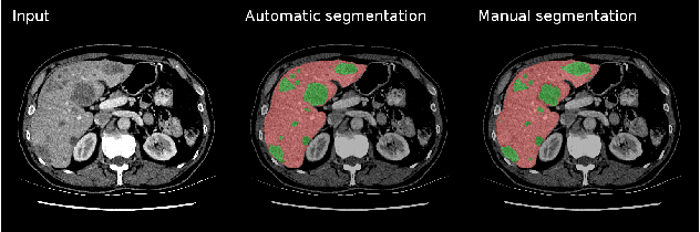 Figure 3 for Liver lesion segmentation informed by joint liver segmentation