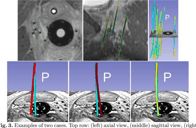Figure 2 for Model-based Catheter Segmentation in MRI-images