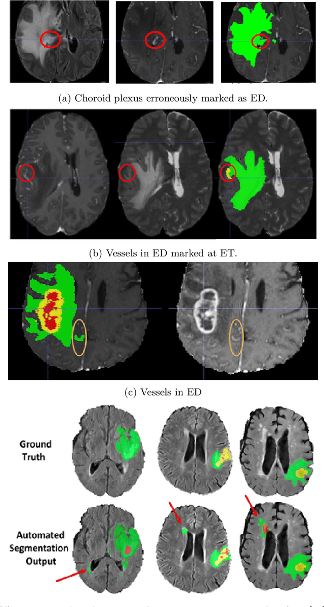 Figure 3 for The RSNA-ASNR-MICCAI BraTS 2021 Benchmark on Brain Tumor Segmentation and Radiogenomic Classification
