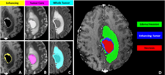 Figure 1 for The RSNA-ASNR-MICCAI BraTS 2021 Benchmark on Brain Tumor Segmentation and Radiogenomic Classification