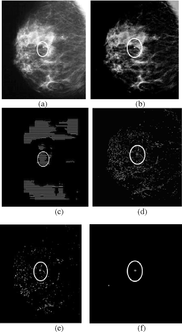 Figure 2 for Detection of Microcalcification in Mammograms Using Wavelet Transform and Fuzzy Shell Clustering