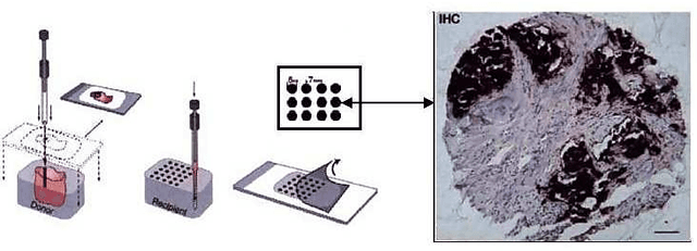 Figure 1 for Incorporating Deep Features in the Analysis of Tissue Microarray Images