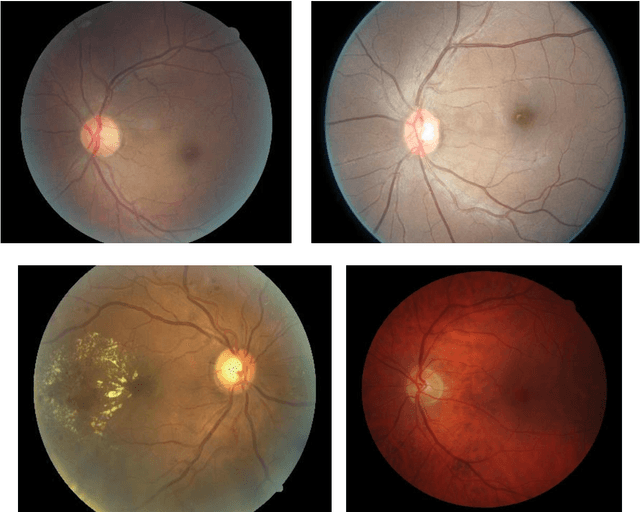 Figure 4 for Deep Learning for Automated Quality Assessment of Color Fundus Images in Diabetic Retinopathy Screening