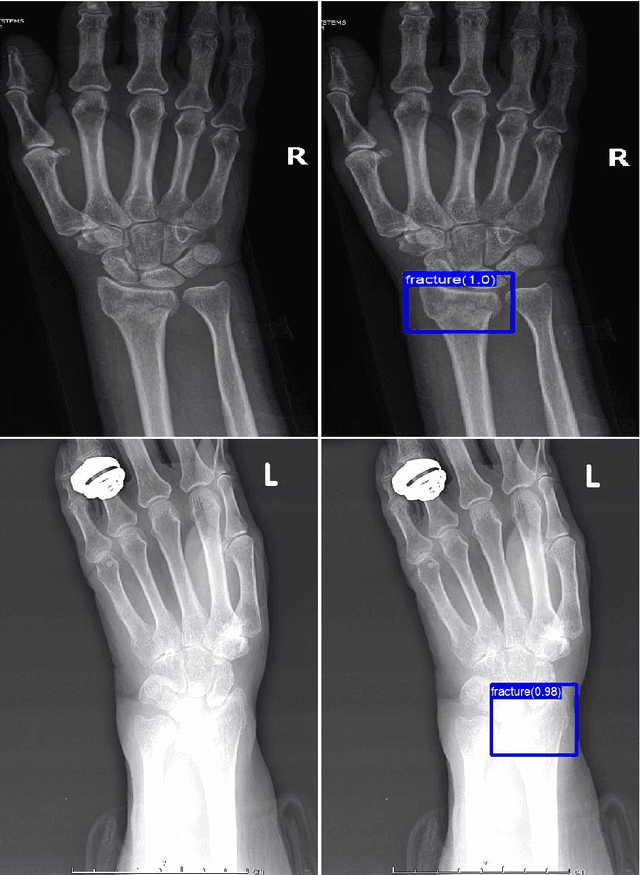 Figure 3 for Detection of distal radius fractures trained by a small set of X-ray images and Faster R-CNN
