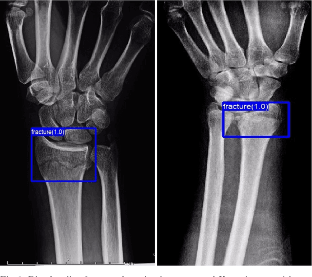 Figure 4 for Detection of distal radius fractures trained by a small set of X-ray images and Faster R-CNN