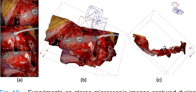 Figure 2 for Real-time Dense Reconstruction of Tissue Surface from Stereo Optical Video