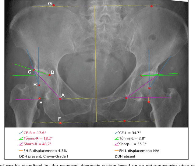 Figure 1 for Deep Learning-Based Automatic Diagnosis System for Developmental Dysplasia of the Hip