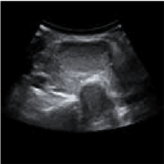 Figure 3 for Segmentation of ultrasound images of thyroid nodule for assisting fine needle aspiration cytology