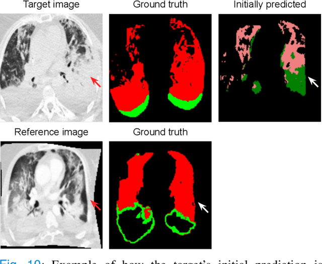 Figure 2 for Interactive Segmentation for COVID-19 Infection Quantification on Longitudinal CT scans