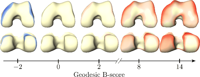 Figure 1 for Geodesic B-Score for Improved Assessment of Knee Osteoarthritis