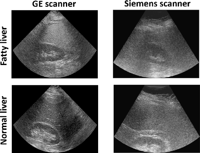 Figure 1 for Adversarial attacks on deep learning models for fatty liver disease classification by modification of ultrasound image reconstruction method