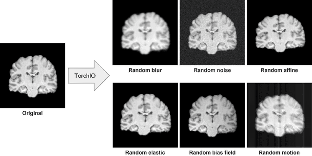 Figure 2 for Detecting Schizophrenia with 3D Structural Brain MRI Using Deep Learning