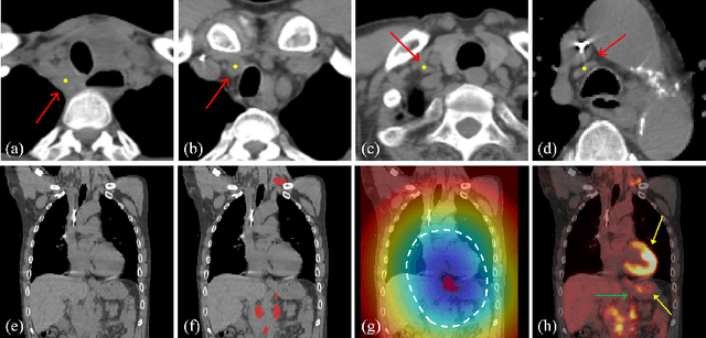 Figure 1 for Lymph Node Gross Tumor Volume Detection and Segmentation via Distance-based Gating using 3D CT/PET Imaging in Radiotherapy