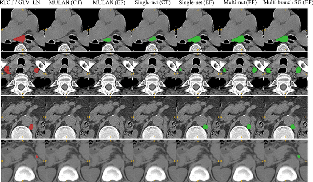 Figure 4 for Lymph Node Gross Tumor Volume Detection and Segmentation via Distance-based Gating using 3D CT/PET Imaging in Radiotherapy