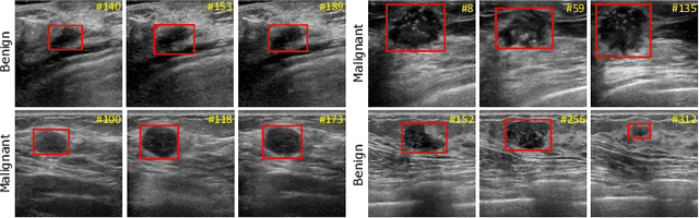 Figure 1 for A New Dataset and A Baseline Model for Breast Lesion Detection in Ultrasound Videos