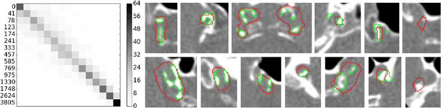 Figure 4 for Segmentation of Intracranial Arterial Calcification with Deeply Supervised Residual Dropout Networks