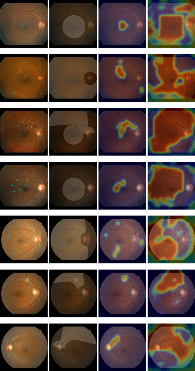 Figure 4 for Classification of Findings with Localized Lesions in Fundoscopic Images using a Regionally Guided CNN
