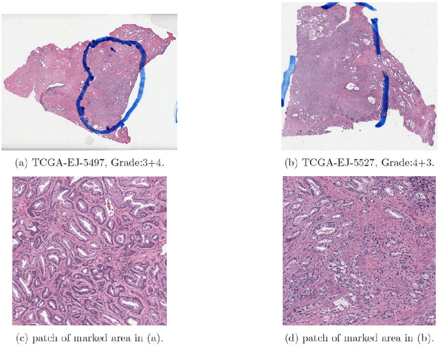 Figure 1 for Large scale digital prostate pathology image analysis combining feature extraction and deep neural network