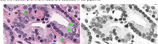 Figure 3 for Large scale digital prostate pathology image analysis combining feature extraction and deep neural network