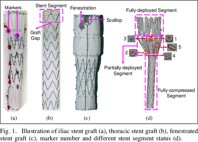 Figure 1 for Real-time 3D Shape Instantiation for Partially-deployed Stent Segment from a Single 2D Fluoroscopic Image in Robot-assisted Fenestrated Endovascular Aortic Repair