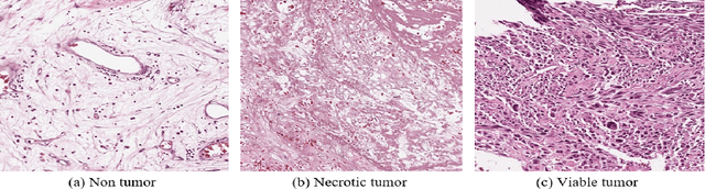 Figure 1 for A Deep Learning Study on Osteosarcoma Detection from Histological Images