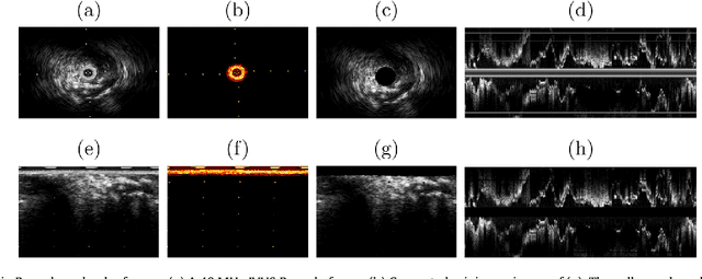 Figure 1 for Segmentation of Arterial Walls in Intravascular Ultrasound Cross-Sectional Images Using Extremal Region Selection