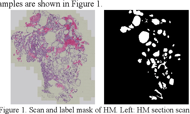 Figure 1 for A Semantic Segmentation Network Based Real-Time Computer-Aided Diagnosis System for Hydatidiform Mole Hydrops Lesion Recognition in Microscopic View