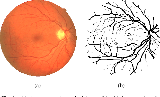 Figure 1 for Blood Vessel Detection using Modified Multiscale MF-FDOG Filters for Diabetic Retinopathy
