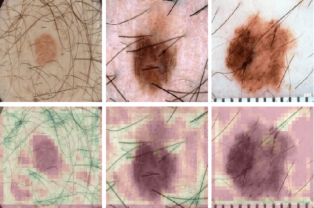 Figure 4 for Visualizing Convolutional Neural Networks to Improve Decision Support for Skin Lesion Classification