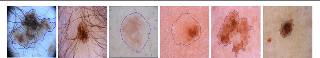Figure 1 for Semi-supervised Skin Lesion Segmentation via Transformation Consistent Self-ensembling Model