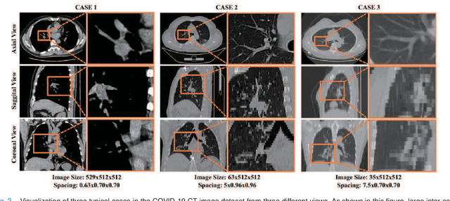 Figure 2 for Synergistic Learning of Lung Lobe Segmentation and Hierarchical Multi-Instance Classification for Automated Severity Assessment of COVID-19 in CT Images