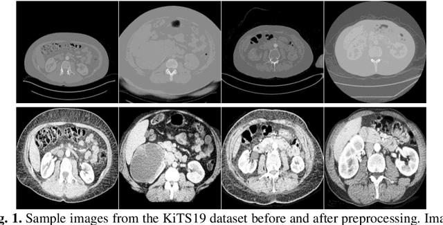 Figure 1 for Kidney and Kidney Tumor Segmentation using a Logical Ensemble of U-nets with Volumetric Validation