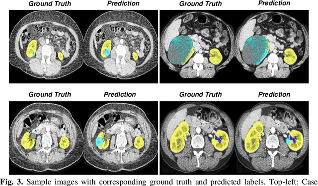 Figure 4 for Kidney and Kidney Tumor Segmentation using a Logical Ensemble of U-nets with Volumetric Validation