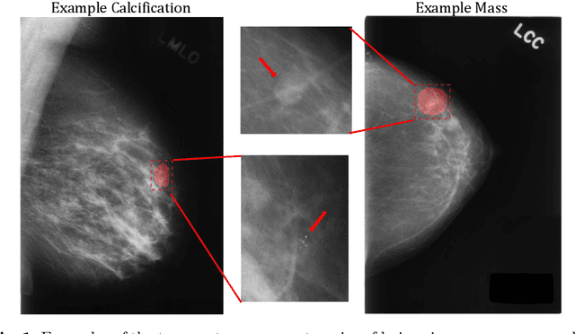 Figure 1 for A Multi-Scale CNN and Curriculum Learning Strategy for Mammogram Classification