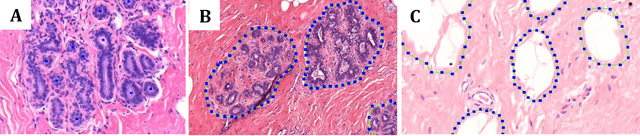 Figure 1 for Deep learning assessment of breast terminal duct lobular unit involution: towards automated prediction of breast cancer risk