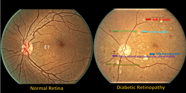 Figure 1 for A Benchmark for Studying Diabetic Retinopathy: Segmentation, Grading, and Transferability