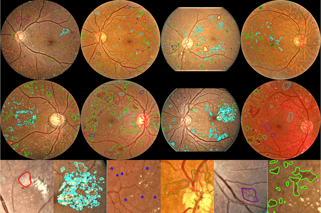 Figure 2 for A Benchmark for Studying Diabetic Retinopathy: Segmentation, Grading, and Transferability