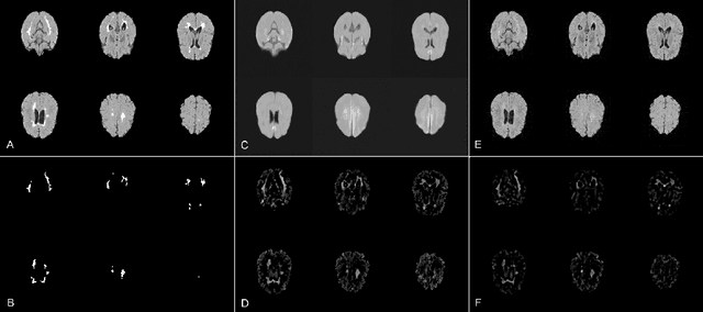 Figure 3 for Scale-Space Autoencoders for Unsupervised Anomaly Segmentation in Brain MRI