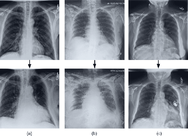 Figure 1 for CheXplaining in Style: Counterfactual Explanations for Chest X-rays using StyleGAN