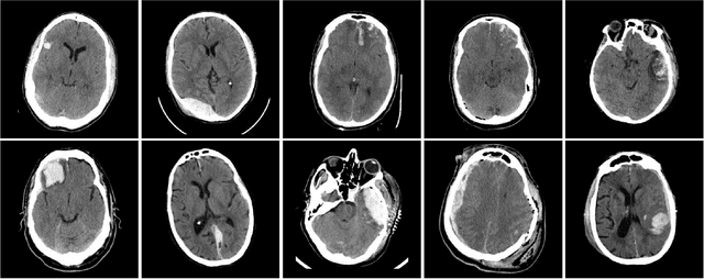 Figure 1 for Distributed deep learning for robust multi-site segmentation of CT imaging after traumatic brain injury