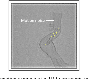 Figure 2 for Real-time 3D Shape Instantiation from Single Fluoroscopy Projection for Fenestrated Stent Graft Deployment