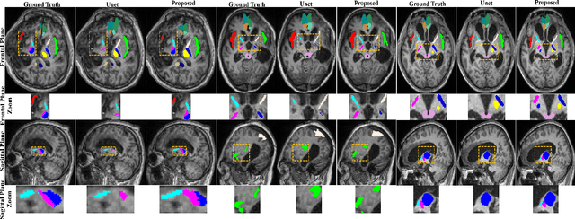 Figure 3 for Robust Brain Magnetic Resonance Image Segmentation for Hydrocephalus Patients: Hard and Soft Attention