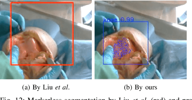 Figure 4 for Occlusion-robust Visual Markerless Bone Tracking for Computer-Assisted Orthopaedic Surgery