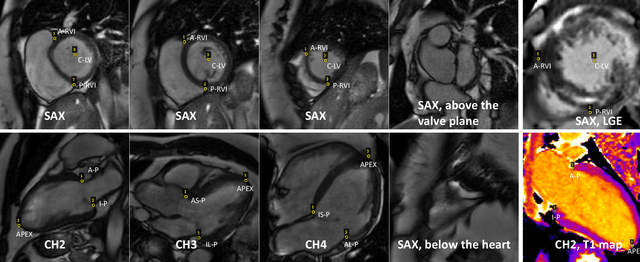 Figure 2 for Landmark detection in Cardiac Magnetic Resonance Imaging Using A Convolutional Neural Network