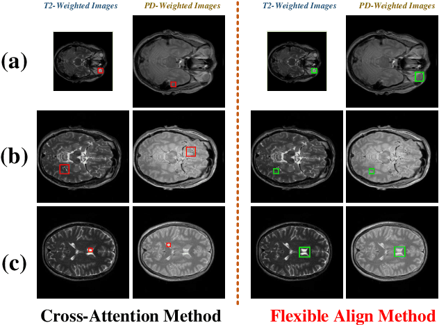 Figure 1 for Flexible Alignment Super-Resolution Network for Multi-Contrast MRI