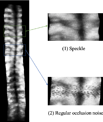 Figure 2 for Bone Feature Segmentation in Ultrasound Spine Image with Robustness to Speckle and Regular Occlusion Noise