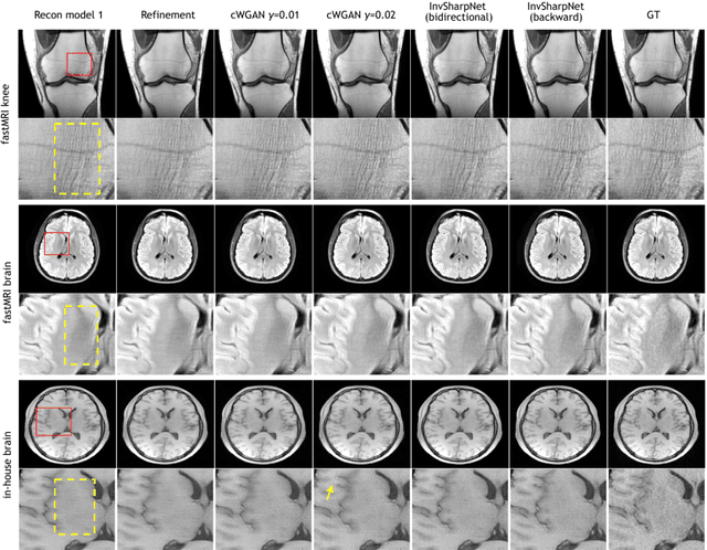 Figure 3 for Invertible Sharpening Network for MRI Reconstruction Enhancement