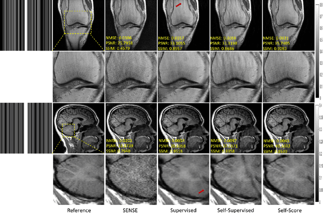 Figure 4 for Self-Score: Self-Supervised Learning on Score-Based Models for MRI Reconstruction