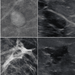 Figure 1 for Automatic Breast Lesion Classification by Joint Neural Analysis of Mammography and Ultrasound