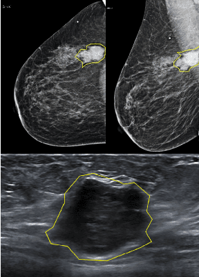 Figure 3 for Automatic Breast Lesion Classification by Joint Neural Analysis of Mammography and Ultrasound